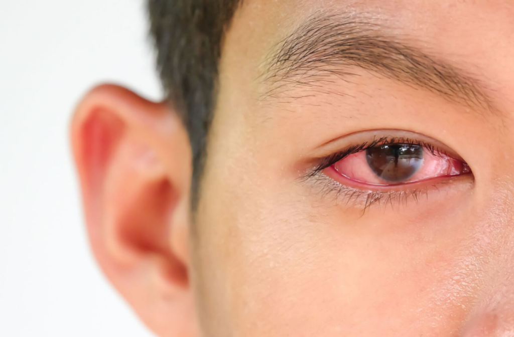 A close-up eye of a man with photokeratitis,  red and swelling eye.