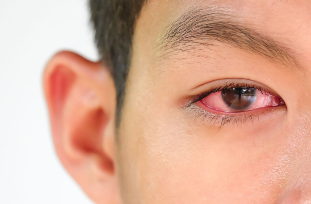 A close-up eye of a man with photokeratitis, sunburned red and swelling eye.