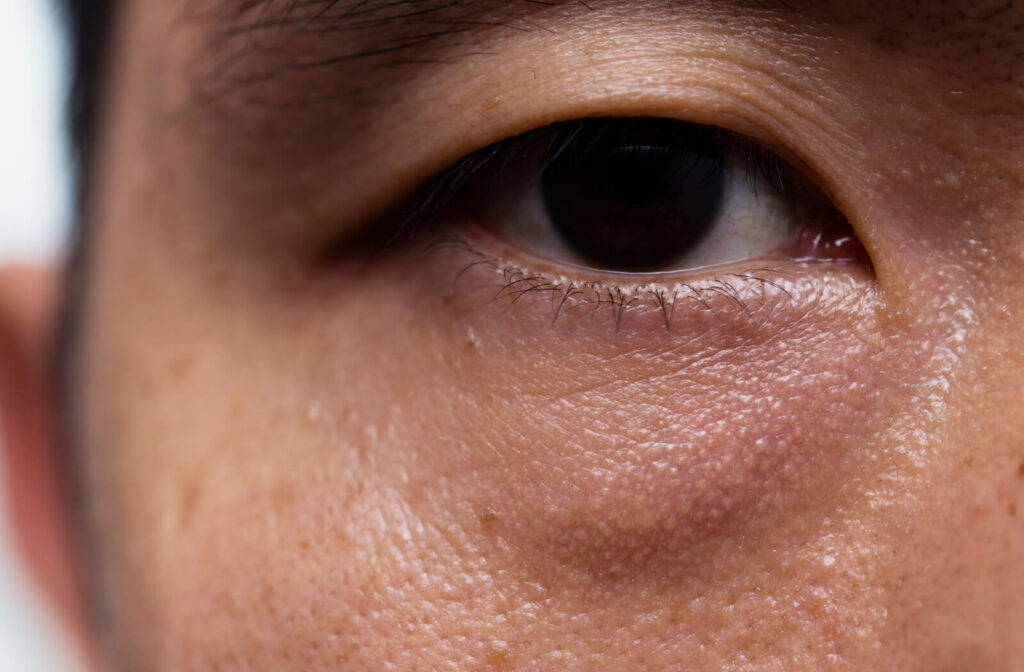 A close-up of an eye of a man with droopy eyelids.