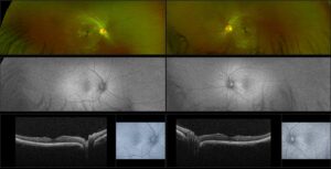 glaucoma-retina-optos-optomap-multi-mode-monaco-silverstone-macula-macular-degeneration-diabetes