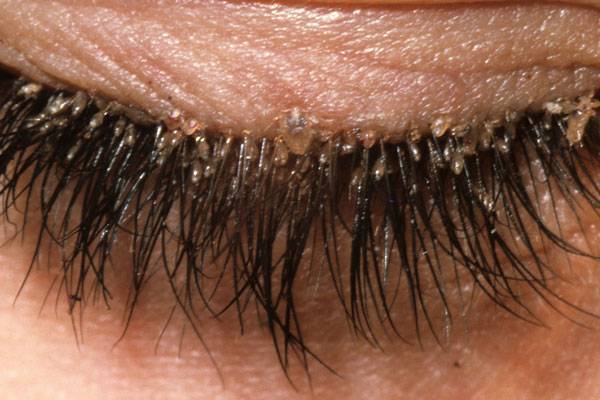 demodex-lashes-eyelid-eyelashes-eye-health-bleph-blepharitis-flakes-flaky