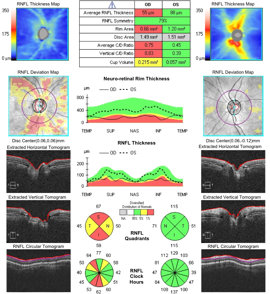 oct-imaging-optical-coherence-tomography-octa-eye-disease-glaucoma-diabetes-diabetic-retinopathy-macualr-degeneration-drusen-blindness-vision-optometry-optometrist-eye-care-eyecare-risk-assessment