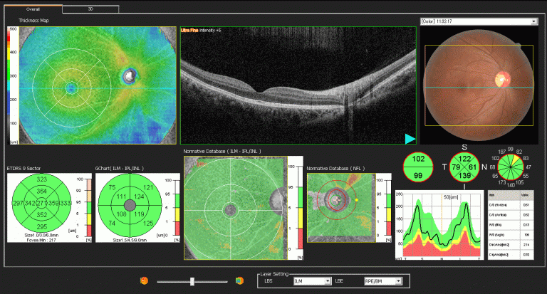 oct-imaging-optical-coherence-tomography-octa-eye-disease-glaucoma-diabetes-diabetic-retinopathy-macualr-degeneration-drusen-blindness-vision-optometry-optometrist-eye-care-eyecare-risk-assessment