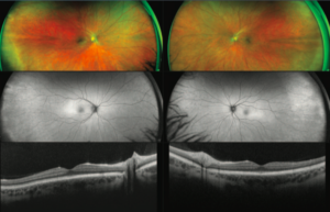 oct-imaging-optical-coherence-tomography-octa-eye-disease-cataracts-glaucoma-diabetes-diabetic-retinopathy-macualr-degeneration-drusen-blindness-vision-optometry-optometrist-eye-care-eyecare-risk-assessment-diabetic-eye-exam-a1c-retinal-screening-optos-optomap-fundus-optometrist-optometry-eye-doctor