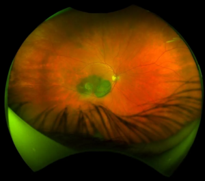 optometry-eyes-eyewear-eyeglasses-glasses-lenses-blue-light-filter-exposure-eye-fatigue-strain-dry-how-often-schedule-eye-exam-annual-comprehensive-cee-aee-optometrist-optical-illusions-eye-care-eyecare-oct-imaging-optical-coherence-tomography-octa-eye-disease-cataracts-glaucoma-diabetes-diabetic-retinopathy-macular-degeneration-drusen-blindness-vision-optometrist-eye-care-eyecare-risk-assessment-diabetic-eye-exam-a1c-retinal-screening-optos-optomap-fundus-eye-doctor-comanagement-lasik-consultation-refractive surgery--retinal-screening-fundus-photography-nevus-melanoma-eye-cancer