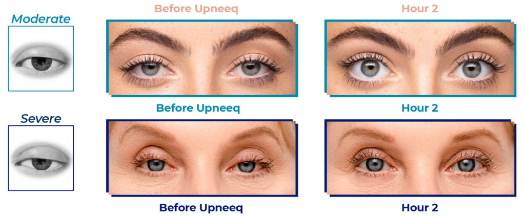 optometry-eyes-eyewear-eyeglasses-glasses-lenses-blue-light-filter-exposure-eye-fatigue-strain-dry-how-often-schedule-eye-exam-annual-comprehensive-cee-aee-optometrist-optical-illusions-eye-care-eyecare-oct-imaging-optical-coherence-tomography-octa-eye-disease-cataracts-glaucoma-diabetes-diabetic-retinopathy-macular-degeneration-drusen-blindness-vision-optometrist-eye-care-eyecare-risk-assessment-diabetic-eye-exam-a1c-retinal-screening-optos-optomap-fundus-eye-doctor-comanagement-lasik-consultation-refractive surgery--retinal-screening-fundus-photography-nevus-melanoma-eye-cancer-optomap-retinal-imaging-onjunctivitis-viral-bacterial-fungal-allergic-pink-eye-optometrists-vs-ophthalmologists-vs-opticians-lasik-evo-icl-refractive-surgery-upneeq-droopy-eyelids-lids-acquired-ptosis