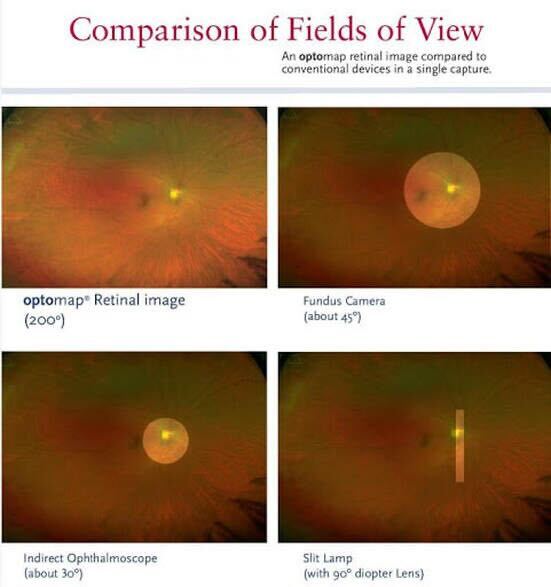 optometry-eyes-eyewear-eyeglasses-glasses-lenses-blue-light-filter-exposure-eye-fatigue-strain-dry-how-often-schedule-eye-exam-annual-comprehensive-cee-aee-optometrist-optical-illusions-eye-care-eyecare-oct-imaging-optical-coherence-tomography-octa-eye-disease-cataracts-glaucoma-diabetes-diabetic-retinopathy-macular-degeneration-drusen-blindness-vision-optometrist-eye-care-eyecare-risk-assessment-diabetic-eye-exam-a1c-retinal-screening-optos-optomap-fundus-eye-doctor-comanagement-lasik-consultation-refractive surgery--retinal-screening-fundus-photography-nevus-melanoma-eye-cancer-optomap-retinal-imaging-onjunctivitis-viral-bacterial-fungal-allergic-pink-eye-optometrists-vs-ophthalmologists-vs-opticians-lasik-evo-icl-refractive-surgery-upneeq-droopy-eyelids-lids-acquired-ptosis-eye-dilations