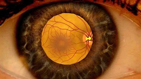 optometry-eyes-eyewear-eyeglasses-glasses-lenses-blue-light-filter-exposure-eye-fatigue-strain-dry-how-often-schedule-eye-exam-annual-comprehensive-cee-aee-optometrist-optical-illusions-eye-care-eyecare-oct-imaging-optical-coherence-tomography-octa-eye-disease-cataracts-glaucoma-diabetes-diabetic-retinopathy-macular-degeneration-drusen-blindness-vision-optometrist-eye-care-eyecare-risk-assessment-diabetic-eye-exam-a1c-retinal-screening-optos-optomap-fundus-eye-doctor-comanagement-lasik-consultation-refractive surgery--retinal-screening-fundus-photography-nevus-melanoma-eye-cancer-optomap-retinal-imaging-onjunctivitis-viral-bacterial-fungal-allergic-pink-eye-optometrists-vs-ophthalmologists-vs-opticians-lasik-evo-icl-refractive-surgery-upneeq-droopy-eyelids-lids-acquired-ptosis-eye-dilations