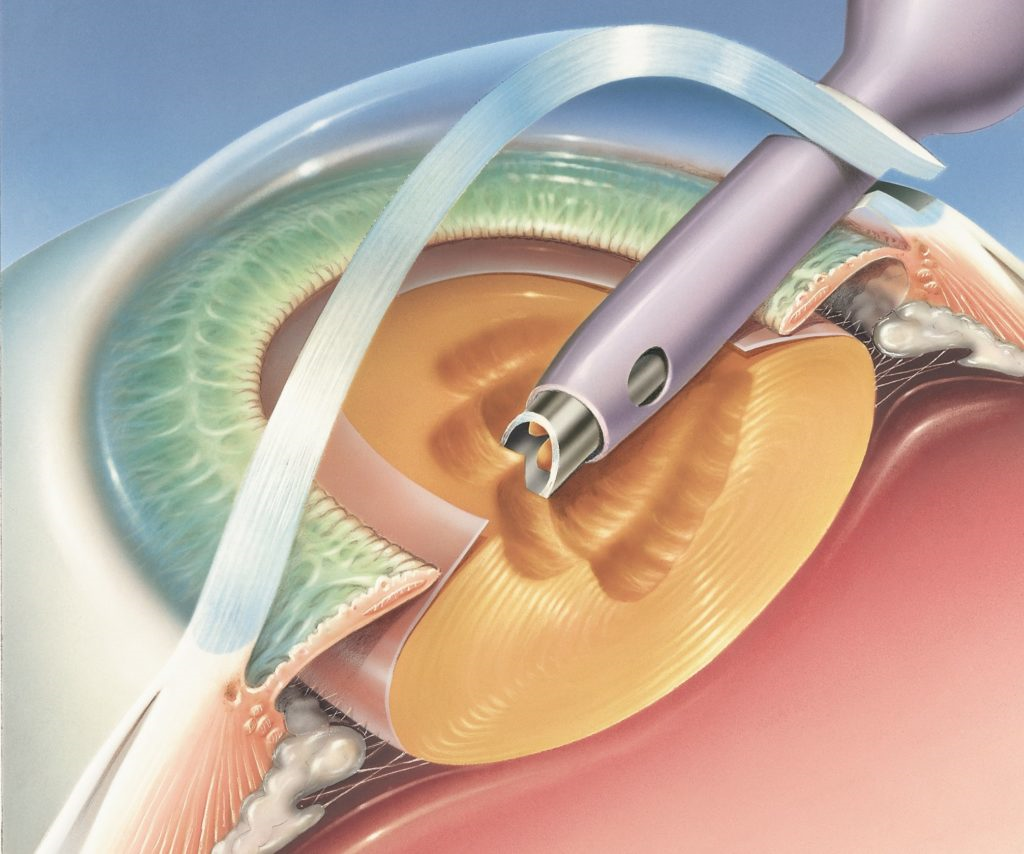 optometry-eyes-eyewear-eyeglasses-glasses-lenses-blue-light-filter-exposure-eye-fatigue-strain-dry-how-often-schedule-eye-exam-annual-comprehensive-cee-aee-optometrist-optical-illusions-eye-care-eyecare-oct-imaging-optical-coherence-tomography-octa-eye-disease-cataracts-glaucoma-diabetes-diabetic-retinopathy-macular-degeneration-drusen-blindness-vision-optometrist-eye-care-eyecare-risk-assessment-diabetic-eye-exam-a1c-retinal-screening-optos-optomap-fundus-eye-doctor-comanagement-lasik-consultation-refractive surgery--retinal-screening-fundus-photography-nevus-melanoma-eye-cancer-optomap-retinal-imaging-onjunctivitis-viral-bacterial-fungal-allergic-pink-eye-optometrists-vs-ophthalmologists-vs-opticians-lasik-evo-icl-refractive-surgery-evoicl-cataract-surgery