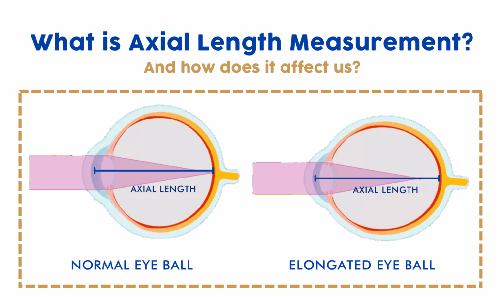 optometry-eyes-eyewear-eyeglasses-glasses-lenses-blue-light-filter-exposure-eye-fatigue-strain-dry-how-often-schedule-eye-exam-annual-comprehensive-cee-aee-optometrist-optical-illusions-eye-care-eyecare-oct-imaging-optical-coherence-tomography-octa-eye-disease-cataracts-glaucoma-diabetes-diabetic-retinopathy-macular-degeneration-drusen-blindness-vision-optometrist-eye-care-eyecare-risk-assessment-diabetic-eye-exam-a1c-retinal-screening-optos-optomap-fundus-eye-doctor-comanagement-lasik-consultation-refractive surgery--retinal-screening-fundus-photography-nevus-melanoma-eye-causes-of-myopia-management-control-nearsightedness