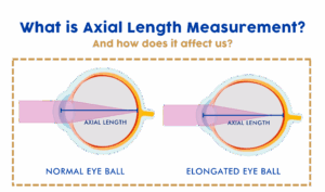 optometry-eyes-eyewear-eyeglasses-glasses-lenses-blue-light-filter-exposure-eye-fatigue-strain-dry-how-often-schedule-eye-exam-annual-comprehensive-cee-aee-optometrist-optical-illusions-eye-care-eyecare-oct-imaging-optical-coherence-tomography-octa-eye-disease-cataracts-glaucoma-diabetes-diabetic-retinopathy-macular-degeneration-drusen-blindness-vision-optometrist-eye-care-eyecare-risk-assessment-diabetic-eye-exam-a1c-retinal-screening-optos-optomap-fundus-eye-doctor-comanagement-lasik-consultation-refractive surgery--retinal-screening-fundus-photography-nevus-melanoma-eye-cancer-myopia-management-control-nearsightedness