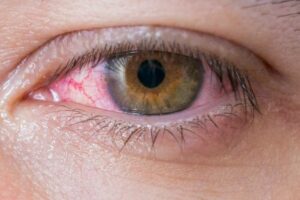 eye-allergies-allergy-season-itchy-swollen-eyes-red-swelling-optometry-dry-eyecare-care-health-exam-tears-crusty-eyes-eyecare