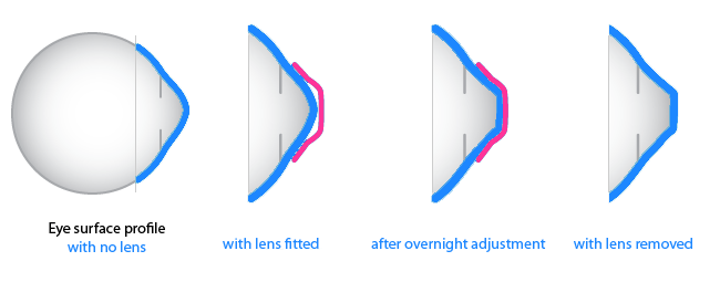 Myopia-Control-Nearsightedness-orthok-orthokeratology