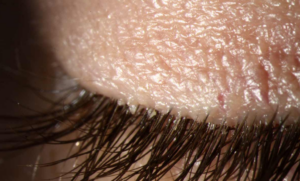 optometry-eyes-eyewear-eyeglasses-glasses-lenses-blue-light-filter-exposure-eye-fatigue-strain-dry-eye-exams-annual-comprehensive-cee-aee-optometrist-optical-illusions-eye-care-eyecare-vision-optometrist-eye-care-eyecare-opticians-eye-doctor-near-me-cartier-lindberg-chrome-hearts-eyewear-glasses-eyeglasses-sunglasses-frames-polarized-designer-luxury-demodex