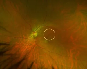 optometry-eyes-eyewear-eyeglasses-glasses-lenses-blue-light-filter-exposure-eye-fatigue-strain-dry-eye-exams-annual-comprehensive-cee-aee-optometrist-optical-illusions-eye-care-eyecare-vision-optometrist-eye-care-eyecare-opticians-eye-doctor-near-me-cartier-lindberg-chrome-hearts-eyewear-glasses-eyeglasses-sunglasses-frames-polarized-designer-luxury-optomap