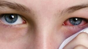 flu-optometry-eyes-eyewear-eyeglasses-glasses-lenses-blue-light-filter-exposure-eye-fatigue-strain-dry-eye-exams-annual-comprehensive-cee-aee-optometrist-optical-illusions-eye-care-eyecare-vision-optometrist-eye-care-eyecare-opticians-eye-doctor-near-me-cartier-lindberg-chrome-hearts-eyewear-glasses-eyeglasses-sunglasses-frames-polarized-designer-luxury