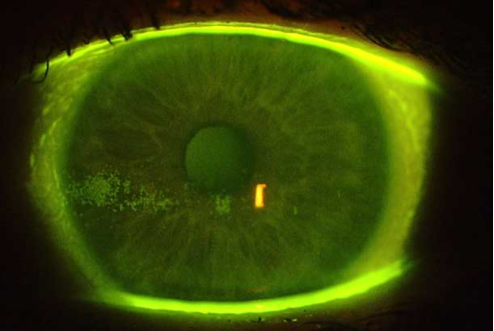 optometry-eyes-eyewear-eyeglasses-glasses-lenses-blue-light-filter-exposure-eye-fatigue-strain-dry-eye-exams-annual-comprehensive-cee-aee-optometrist-optical-illusions-eye-care-eyecare-vision-optometrist-eye-care-eyecare-opticians-eye-doctor-near-me-cartier-lindberg-chrome-hearts-eyewear-glasses-eyeglasses-sunglasses-frames-polarized-designer-luxury-dry-eyes