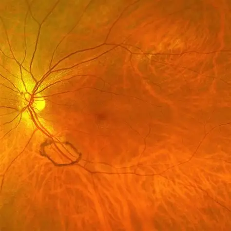 optometry-eyes-eyewear-eyeglasses-glasses-eye-exam-annual-comprehensive-cee-aee-optometrist-optical-illusions-eye-care-eyecare-disease-cataracts-glaucoma-diabetes-diabetic-retinopathy-macular-degeneration-drusen-blindness-vision-optometrist-eye-care-eyecare-diabetic-eye-exam-optical-lenses-eye-floaters-weiss-ring