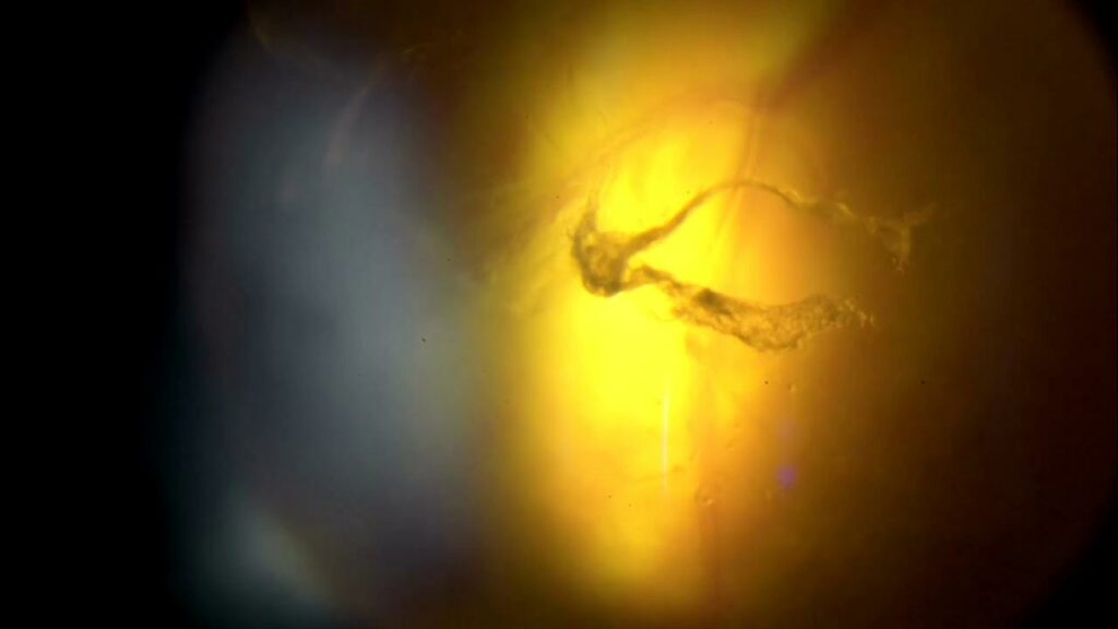 optometry-eyes-eyewear-eyeglasses-glasses-eye-exam-annual-comprehensive-cee-aee-optometrist-optical-illusions-eye-care-eyecare-disease-cataracts-glaucoma-diabetes-diabetic-retinopathy-macular-degeneration-drusen-blindness-vision-optometrist-eye-care-eyecare-diabetic-eye-exam-optical-lenses-eye-floaters-weiss-ring