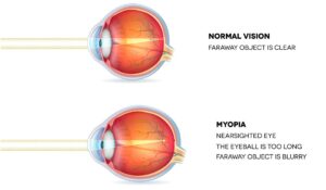 optometry-eyes-eyewear-eyeglasses-glasses-lenses-blue-light-filter-exposure-eye-fatigue-strain-dry-eye-exams-annual-comprehensive-cee-aee-optometrist-optical-illusions-eye-care-eyecare-vision-optometrist-eye-care-eyecare-opticians-eye-doctor-near-me-cartier-lindberg-chrome-hearts-eyewear-glasses-eyeglasses-sunglasses-frames-polarized-designer-luxury-myopia