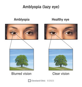 optometry-eyes-eyewear-eyeglasses-glasses-lenses-blue-light-filter-exposure-eye-fatigue-strain-dry-eye-exams-annual-comprehensive-cee-aee-optometrist-optical-illusions-eye-care-eyecare-vision-optometrist-eye-care-eyecare-opticians-eye-doctor-near-me-cartier-lindberg-chrome-hearts-eyewear-sunglasses-frames-polarized-designer-luxury-amblyopia