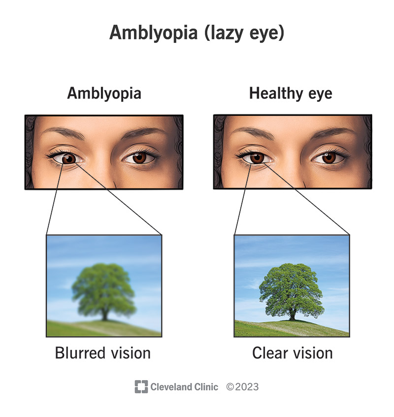 optometry-eyes-eyewear-eyeglasses-glasses-lenses-blue-light-filter-exposure-eye-fatigue-strain-dry-eye-exams-annual-comprehensive-cee-aee-optometrist-optical-illusions-eye-care-eyecare-vision-optometrist-eye-care-eyecare-opticians-eye-doctor-near-me-cartier-lindberg-chrome-hearts-eyewear-sunglasses-frames-polarized-designer-luxury-amblyopia