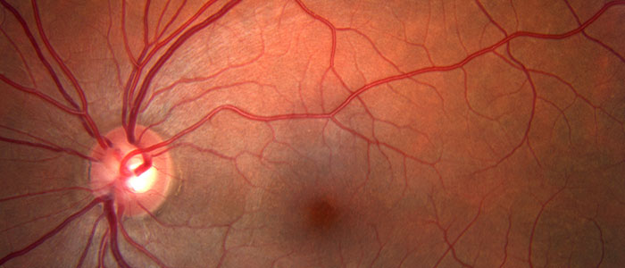 optometry-eyes-eyewear-eyeglasses-glasses-lenses-blue-light-filter-exposure-eye-fatigue-strain-dry-eye-exams-annual-comprehensive-cee-aee-optometrist-optical-illusions-eye-care-eyecare-vision-optometrist-eye-care-eyecare-opticians-eye-doctor-near-me-cartier-lindberg-chrome-hearts-eyewear-glasses-eyeglasses-sunglasses-frames-polarized-designer-luxury-nicotine
