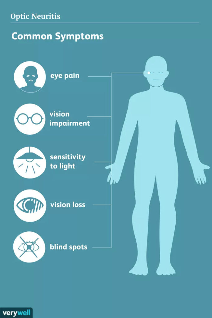 optometry-eyes-eyewear-eyeglasses-glasses-lenses-blue-light-filter-exposure-eye-fatigue-strain-dry-eye-exams-annual-comprehensive-cee-aee-optometrist-optical-illusions-eye-care-eyecare-vision-optometrist-eye-care-eyecare-opticians-eye-doctor-near-me-cartier-lindberg-chrome-hearts-eyewear-glasses-eyeglasses-sunglasses-frames-polarized-designer-luxury
optic neuritis