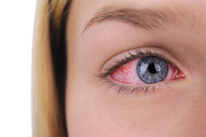 optometry-eyes-eyewear-eyeglasses-glasses-lenses-blue-light-filter-exposure-eye-fatigue-strain-dry-eye-exams-annual-comprehensive-cee-aee-optometrist-optical-illusions-eye-care-eyecare-vision-optometrist-eye-care-eyecare-opticians-eye-doctor-near-me-cartier-lindberg-chrome-hearts-eyewear-glasses-eyeglasses-sunglasses-frames-polarized-designer-luxury-nicotine