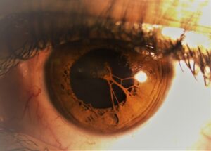 eyelids-optometry-eyes-eyewear-eyeglasses-glasses-lenses-blue-light-filter-exposure-eye-fatigue-strain-dry-eye-exams-annual-comprehensive-cee-aee-optometrist-optical-illusions-eye-care-eyecare-vision-optometrist-eye-care-eyecare-opticians-eye-doctor-near-me-cartier-lindberg-chrome-hearts-eyewear-glasses-eyeglasses-sunglasses-frames-polarized-designer-luxury-love-Pupillary-Membrane-PupillaryMembrane