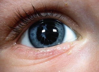 eyelids-optometry-eyes-eyewear-eyeglasses-glasses-lenses-blue-light-filter-exposure-eye-fatigue-strain-dry-eye-exams-annual-comprehensive-cee-aee-optometrist-optical-illusions-eye-care-eyecare-vision-optometrist-eye-care-eyecare-opticians-eye-doctor-near-me-cartier-lindberg-chrome-hearts-eyewear-glasses-eyeglasses-sunglasses-frames-polarized-designer-luxury-love-Pupillary-Membrane-PupillaryMembrane