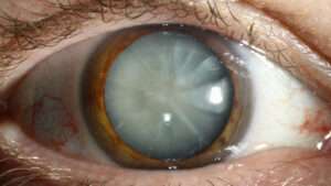 20/20-optometry-eyes-eyewear-eyeglasses-glasses-lenses-blue-light-filter-exposure-eye-fatigue-strain-dry-eye-exams-annual-comprehensive-cee-aee-optometrist-optical-illusions-eye-care-eyecare-vision-optometrist-eye-care-eyecare-opticians-eye-doctor-near-me-cartier-lindberg-chrome-hearts-eyewear-sunglasses-frames-polarized-designer-luxury
