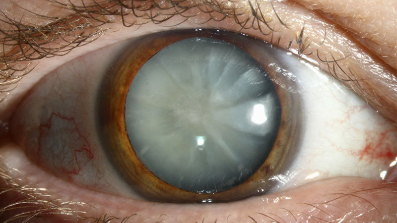 20/20-optometry-eyes-eyewear-eyeglasses-glasses-lenses-blue-light-filter-exposure-eye-fatigue-strain-dry-eye-exams-annual-comprehensive-cee-aee-optometrist-optical-illusions-eye-care-eyecare-vision-optometrist-eye-care-eyecare-opticians-eye-doctor-near-me-cartier-lindberg-chrome-hearts-eyewear-sunglasses-frames-polarized-designer-luxury