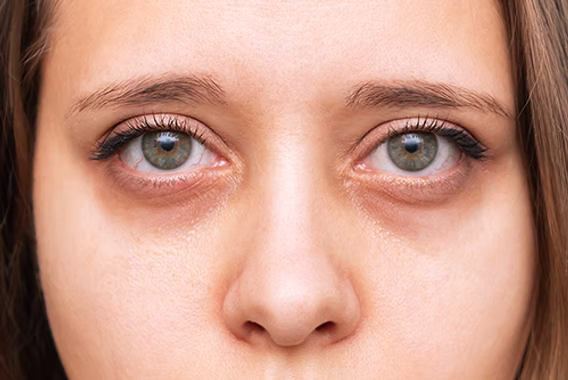 optometry-eyes-eyewear-eyeglasses-glasses-lenses-blue-light-filter-exposure-eye-fatigue-strain-dry-eye-exams-annual-comprehensive-cee-aee-optometrist-optical-illusions-eye-care-eyecare-vision-optometrist-eye-care-eyecare-opticians-eye-doctor-near-me-cartier-lindberg-chrome-hearts-eyewear-glasses-eyeglasses-sunglasses-frames-polarized-designer-luxury-vision-sleep