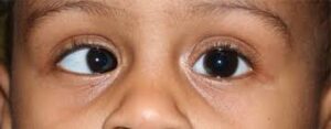 optometry-eyes-eyewear-eyeglasses-glasses-lenses-blue-light-filter-exposure-eye-fatigue-strain-dry-eye-exams-annual-comprehensive-cee-aee-optometrist-optical-illusions-eye-care-eyecare-vision-optometrist-eye-care-eyecare-opticians-eye-doctor-near-me-cartier-lindberg-chrome-hearts-eyewear-glasses-eyeglasses-sunglasses-frames-polarized-designer-luxury-strabismus