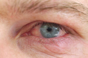 contact-lens-optometry-eyes-eyewear-eyeglasses-glasses-lenses-blue-light-filter-exposure-eye-fatigue-strain-dry-eye-exams-annual-comprehensive-cee-aee-optometrist-optical-illusions-eye-care-eyecare-vision-optometrist-eye-care-eyecare-opticians-eye-doctor-near-me-cartier-lindberg-chrome-hearts-eyewear-glasses-eyeglasses-sunglasses-frames-polarized-designer-luxury