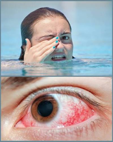 optometry-eyes-eyewear-eyeglasses-glasses-lenses-blue-light-filter-exposure-eye-fatigue-strain-dry-eye-exams-annual-comprehensive-cee-aee-optometrist-optical-illusions-eye-care-eyecare-vision-optometrist-eye-care-eyecare-opticians-eye-doctor-near-me-cartier-lindberg-chrome-hearts-eyewear-glasses-eyeglasses-sunglasses-frames-polarized-designer-luxury-swimmer's eye