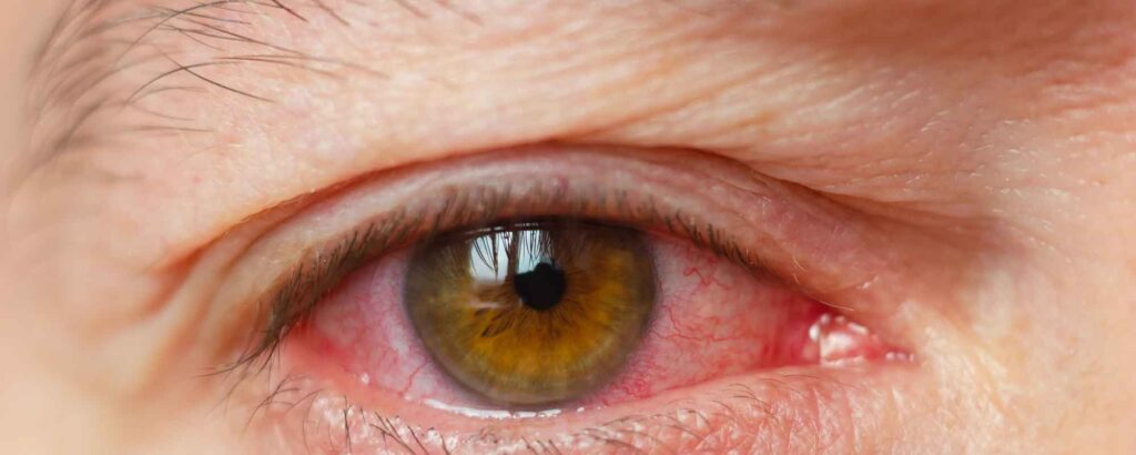 optometry-eyes-eyewear-eyeglasses-glasses-lenses-blue-light-filter-exposure-eye-fatigue-strain-dry-eye-exams-annual-comprehensive-cee-aee-optometrist-optical-illusions-eye-care-eyecare-vision-optometrist-eye-care-eyecare-opticians-eye-doctor-near-me-cartier-lindberg-chrome-hearts-eyewear-glasses-eyeglasses-sunglasses-frames-polarized-designer-luxury-swimmer's eye