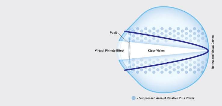 naturalvue-contact-lenses-contacts-optometry-eyes-eyewear-eyeglasses-glasses-lenses-blue-light-filter-exposure-eye-fatigue-strain-dry-eye-exams-annual-comprehensive-cee-aee-optometrist-optical-illusions-eye-care-eyecare-vision-optometrist-eye-care-eyecare-opticians-eye-doctor-near-me-cartier-lindberg-chrome-hearts-eyewear-sunglasses-frames-polarized-designer-luxury