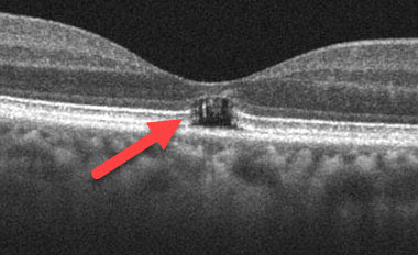 sun-gazing-optometry-eyes-eyewear-eyeglasses-glasses-lenses-blue-light-filter-exposure-eye-fatigue-strain-dry-eye-exams-annual-comprehensive-cee-aee-optometrist-optical-illusions-eye-care-eyecare-vision-optometrist-eye-care-eyecare-opticians-eye-doctor-near-me-cartier-lindberg-chrome-hearts-eyewear-sunglasses-frames-polarized-designer-luxury

