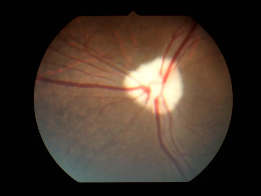 optometry-eyes-eyewear-eyeglasses-glasses-lenses-blue-light-filter-exposure-eye-fatigue-strain-dry-eye-exams-annual-comprehensive-cee-aee-optometrist-optical-illusions-eye-care-eyecare-vision-optometrist-eye-care-eyecare-opticians-eye-doctor-near-me-cartier-lindberg-chrome-hearts-eyewear-glasses-eyeglasses-sunglasses-frames-polarized-designer-luxury-night driving-retinal