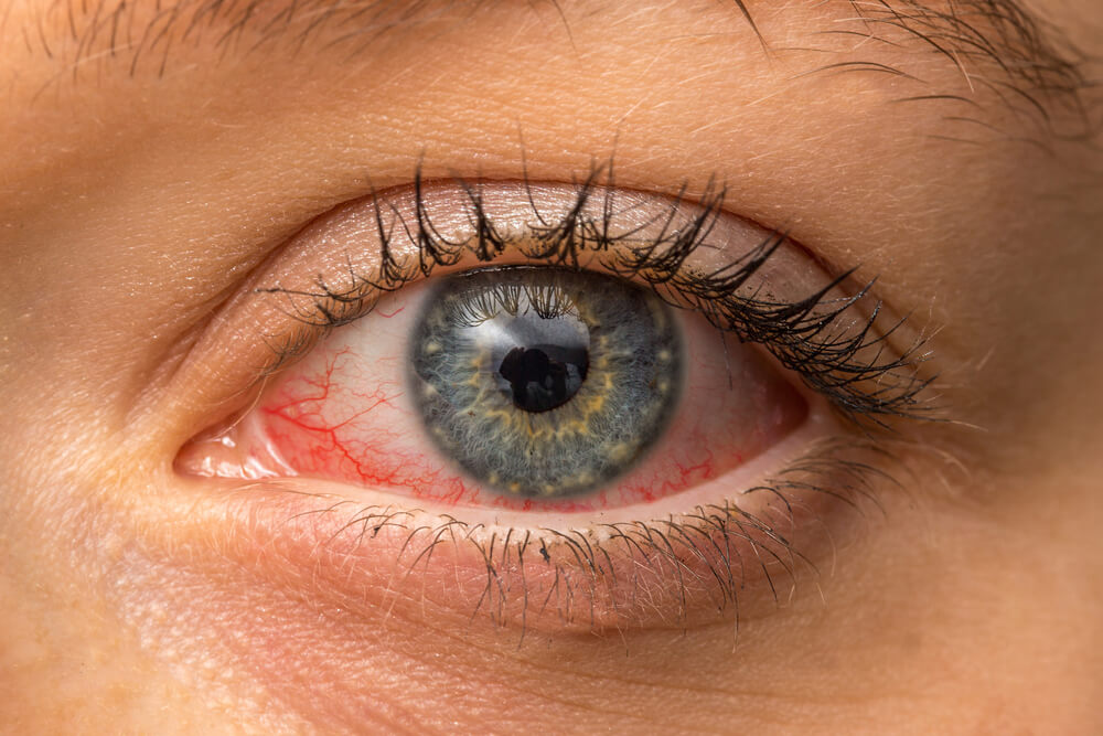 optometry-eyes-eyewear-eyeglasses-glasses-lenses-blue-light-filter-exposure-eye-fatigue-strain-dry-eye-exams-annual-comprehensive-cee-aee-optometrist-optical-illusions-eye-care-eyecare-vision-optometrist-eye-care-eyecare-opticians-eye-doctor-near-me-cartier-lindberg-chrome-hearts-eyewear-sunglasses-frames-polarized-designer-luxury-lasik-dryeye-dry-eye